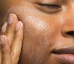 5 tips para eliminar el acné